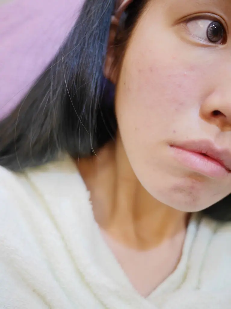 3D聚左旋乳酸術後
