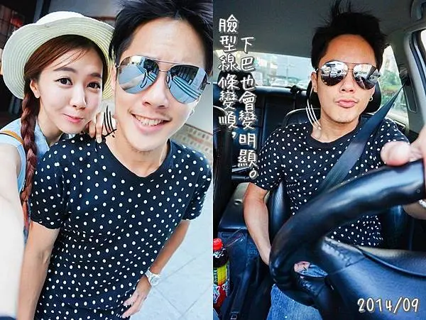肉毒瘦臉術後下巴臉型線條明顯