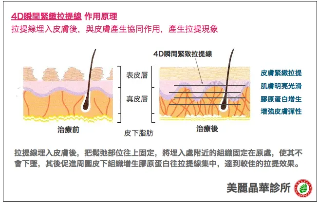 4D瞬間緊緻拉提線作用原理