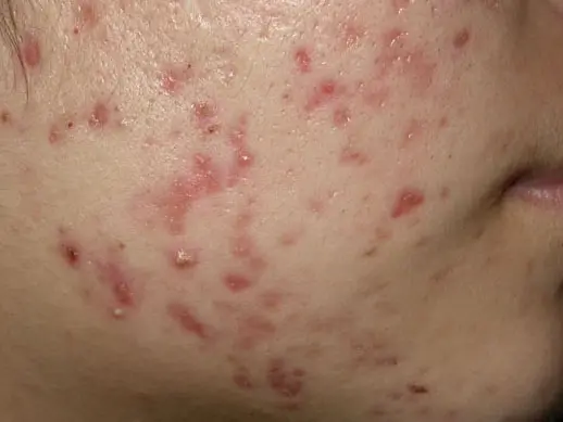 德國光纖粉餅雷射治療色素痘疤
