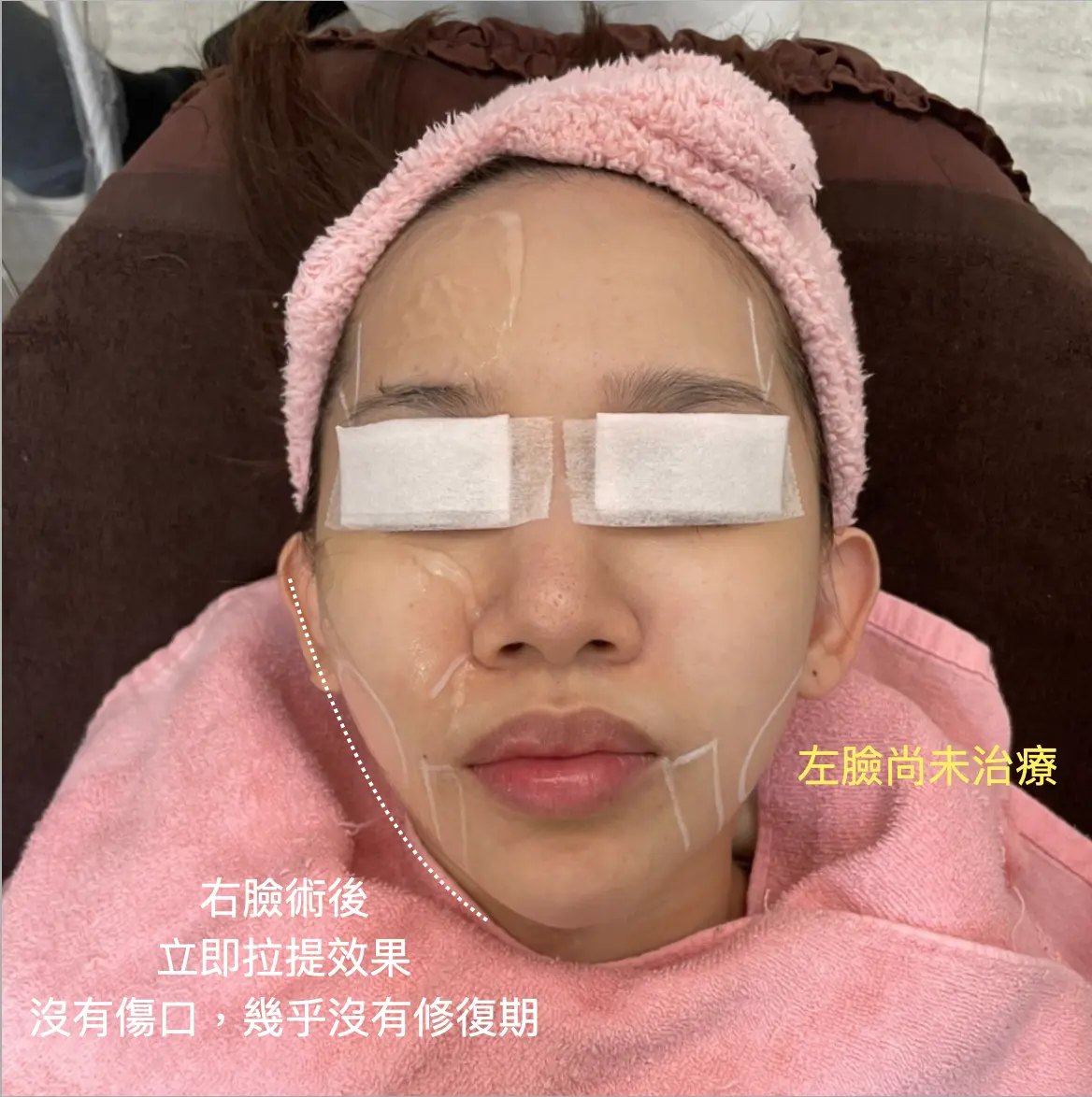 渦旋音波拉提術後立即效果