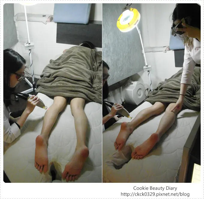 小腿雷射除毛治療過程