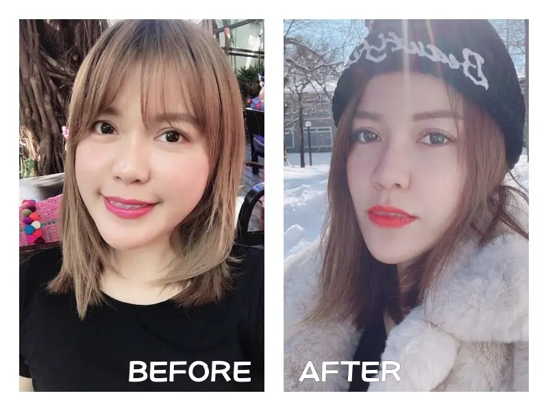 FLX鳳凰電波拉皮網路名人momoco治療分享