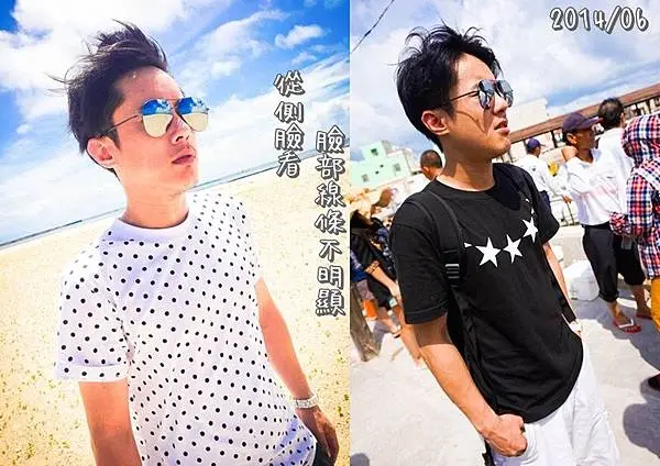 肉毒桿菌瘦小臉術前