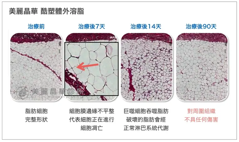 酷塑冷凍溶脂針對脂肪進行破壞