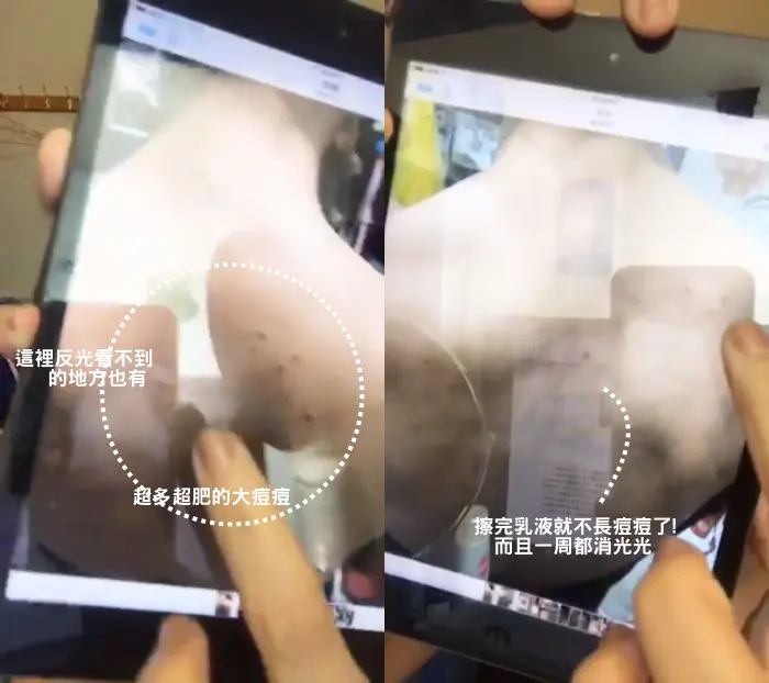 粉餅雷射美背術前