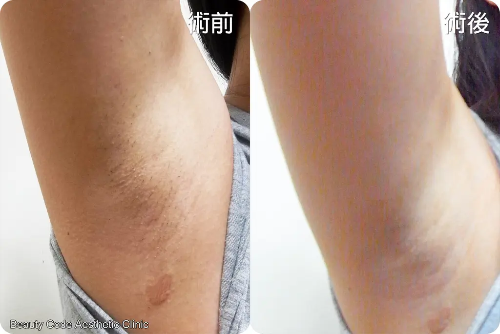 雷射除毛術前術後比較圖