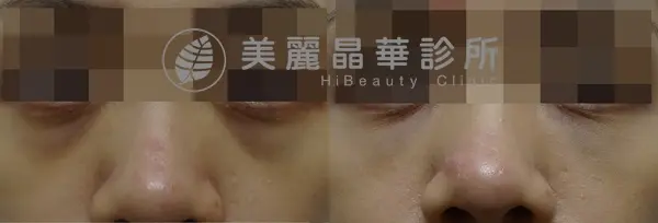 德國光纖粉餅雷射治療色素+血管型黑眼圈