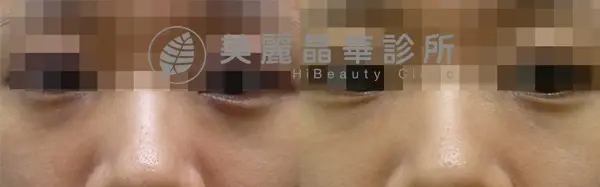 德國光纖粉餅雷射治療頑固色素型黑眼圈