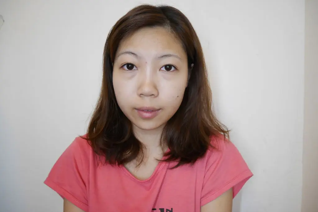玻尿酸淚溝治療前素顏時看起來勞累