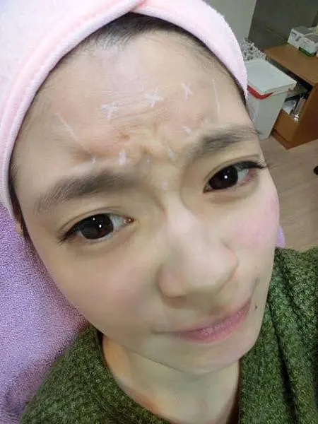肉毒桿菌抬頭紋治療前