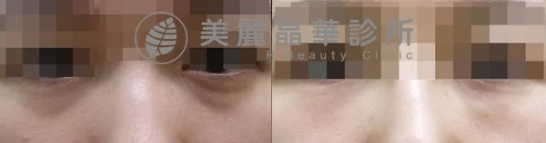 德國光纖粉餅雷射治療色素+淚溝型黑眼圈治療