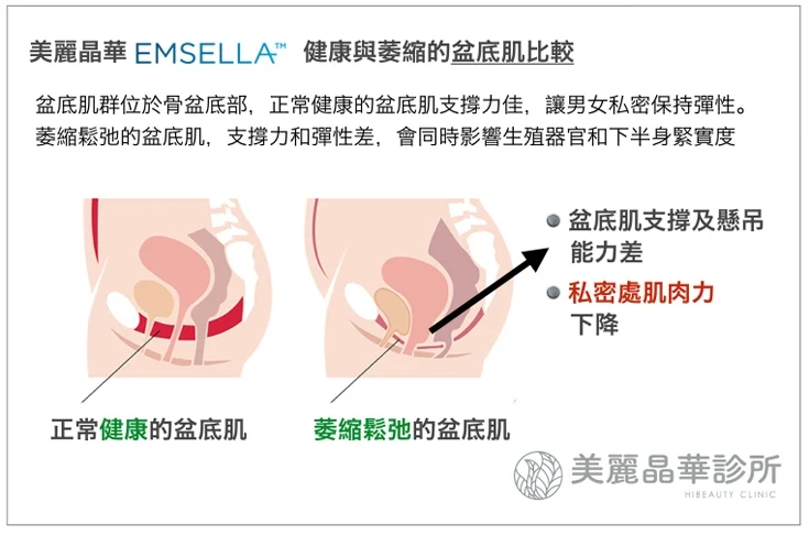 EMSELLA幸福G動椅健康與萎縮的盆底肌比較