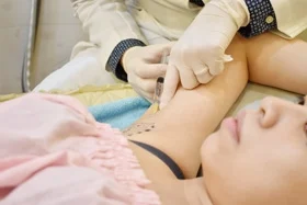 miraDry腋淨爽確認標記治療區域