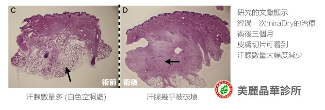 miraDry腋淨爽治療前後汗腺差異