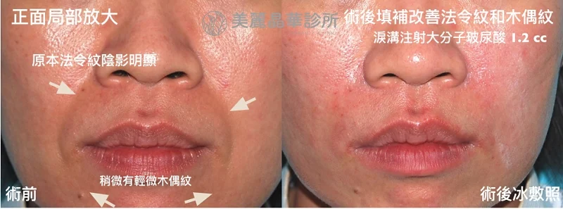 玻尿酸填補法令紋木偶紋術前術後比對