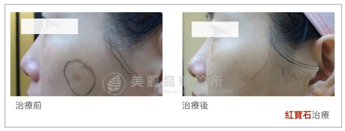 紅寶石雷射案例4