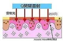 紅寶石雷射Q開關