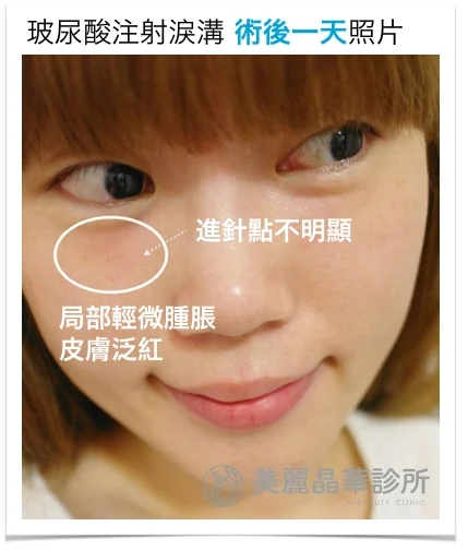 玻尿酸淚溝術後一天照
