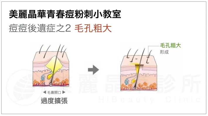 痘痘後遺症-毛孔粗大