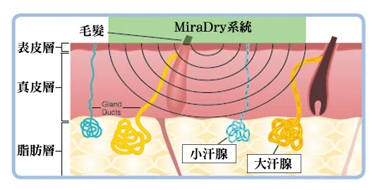 miraDry腋淨爽破壞大小汗腺改善體味汗臭