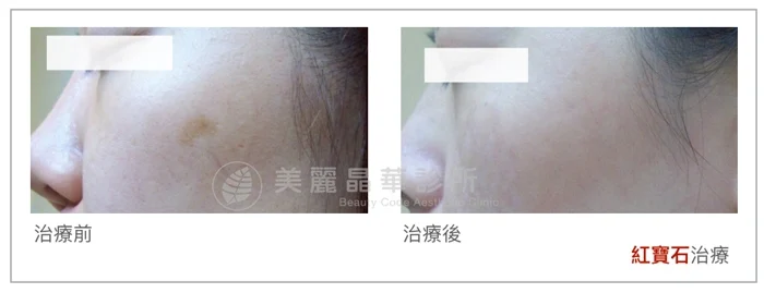 紅寶石雷射案例3