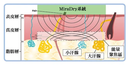 miraDry腋淨爽微波頻率