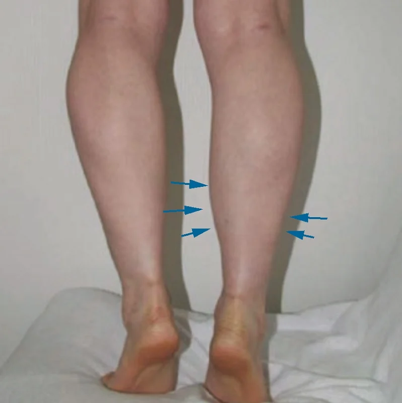 肉毒小腿 瘦小腿 肌肉代償