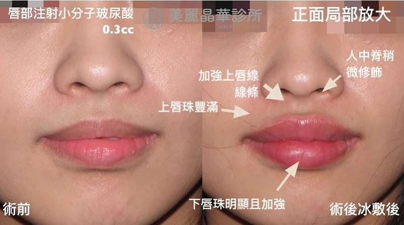 玻尿酸豐唇術前術後立即比對