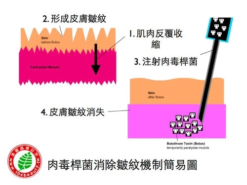 肉毒桿菌消除皺紋機制簡易圖