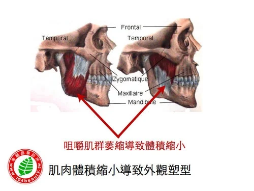 肉毒桿菌肌肉體積縮小塑型