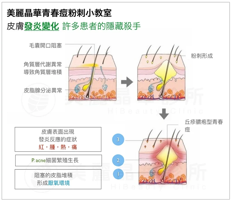 皮膚發炎是青春痘的隱藏殺手