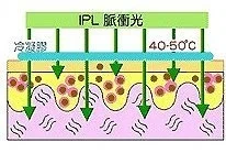 IPL脈衝光