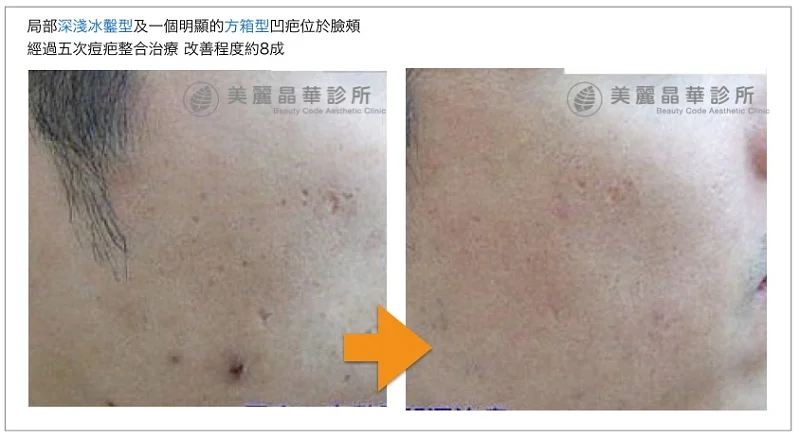 局部深淺冰鑿型與方箱型凹疤治療