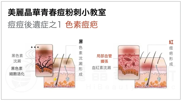 痘痘後遺症-色素痘疤