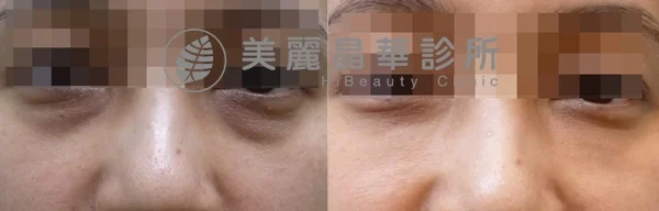 德國光纖粉餅雷射治療色素+老化型黑眼圈