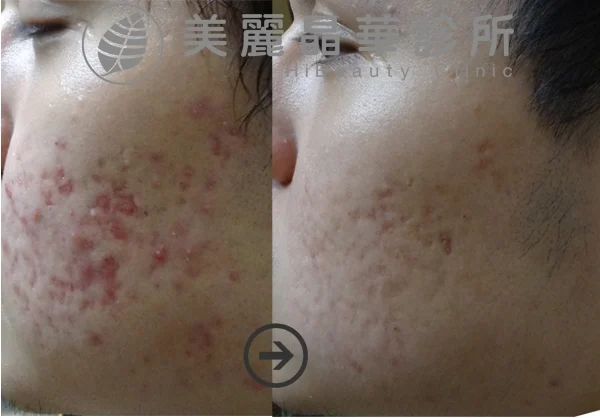 德國光纖粉餅雷射經五次治療改善痘疤及膚質