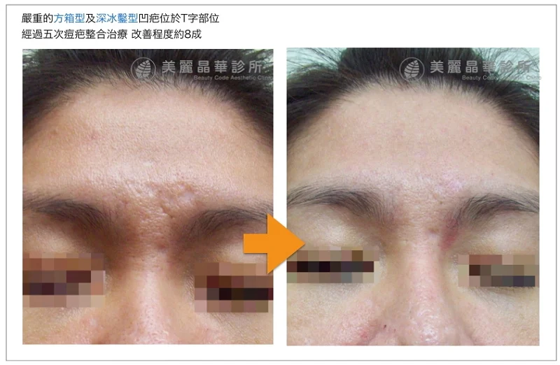 方箱型與深冰鑿型凹疤治療