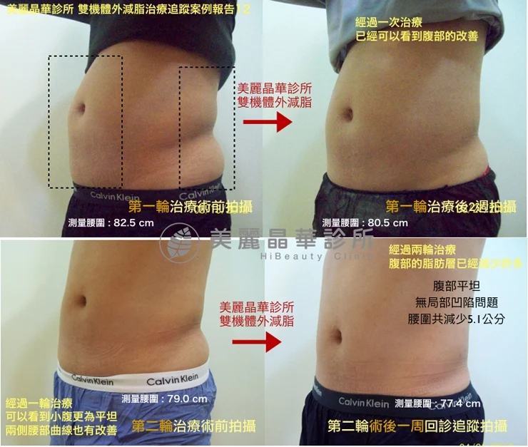 酷塑冷凍溶脂追蹤案例報告12