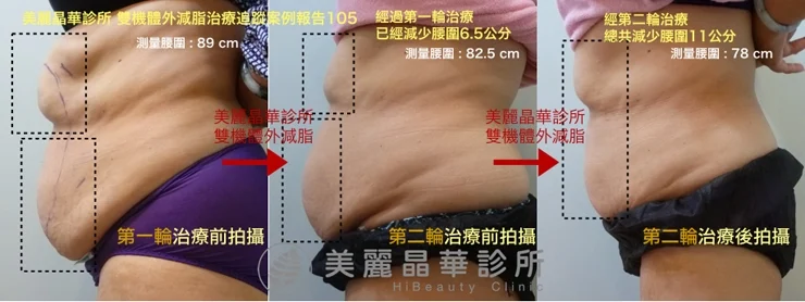 酷塑冷凍溶脂追蹤案例105