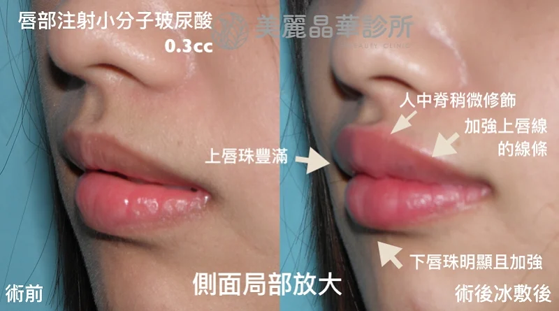 玻尿酸豐唇術前術後側面比對