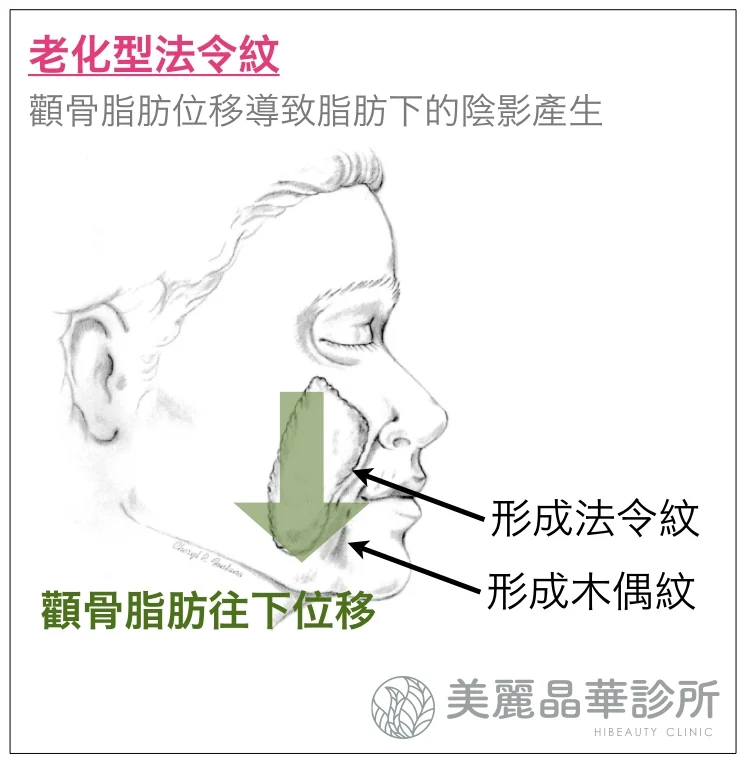 玻尿酸填補老化型法令紋