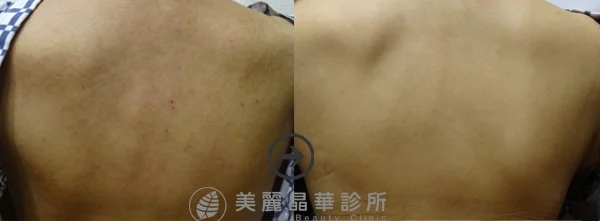 德國光纖粉餅雷射改善背部色素不均