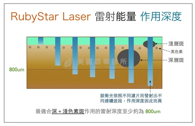 紅寶石雷射除斑能量作用深度