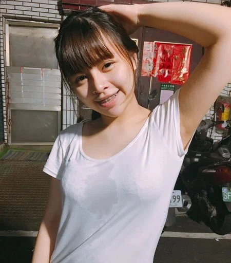 miraDry腋淨爽知名網路紅人治療紀錄