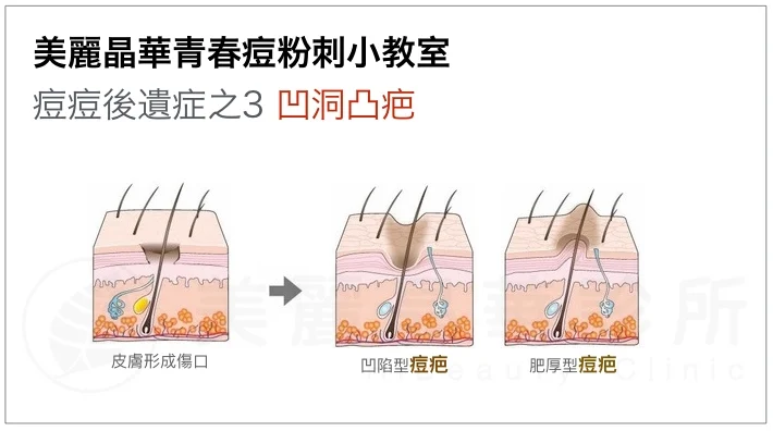 痘痘後遺症-凹洞凸疤