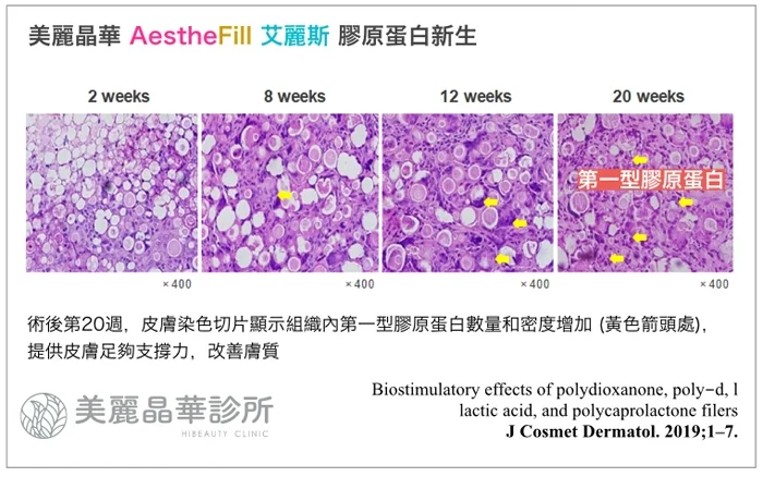 艾麗斯Aesthefill膠原蛋白新生
