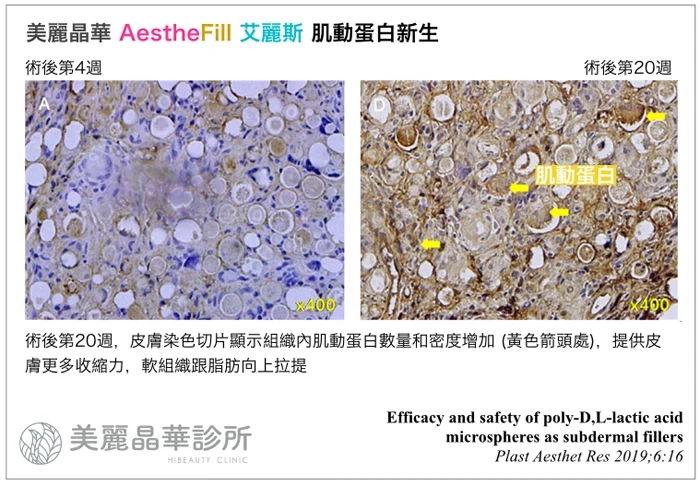 艾麗斯Aesthefill肌動蛋白新生