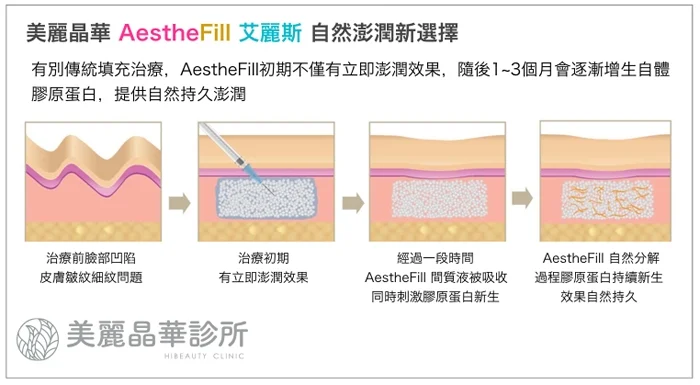 艾麗斯Aesthefill自然澎潤新選擇