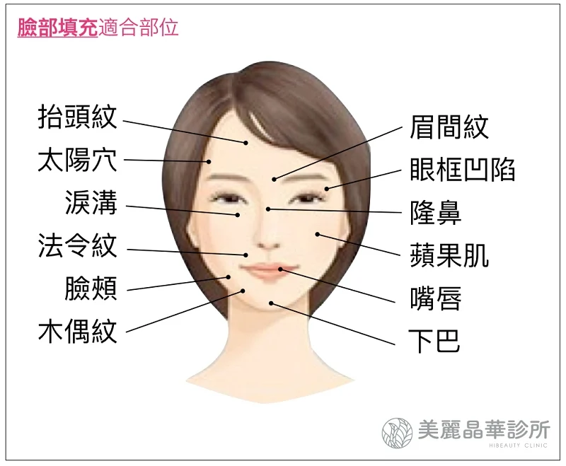 玻尿酸填補適合補位